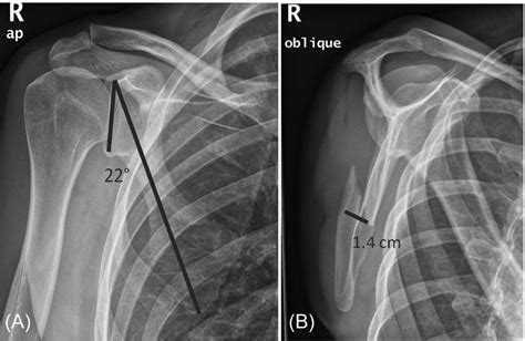 A Meta-Analysis of Operative Versus Nonoperative Treatment In 463 ...