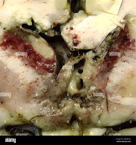 Gross specimen of brain tissue from a patient who died of granulomatous ...