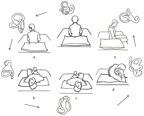 Hallpike Maneuver Illustration