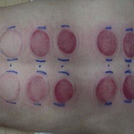 Cupping Colors And What They Mean