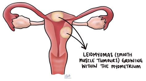 I-leiomyoma yesibeletho | I-MyPathologyReport.ca