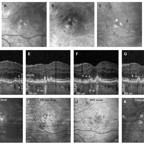 Basal laminar drusen. (A) Colour fundus photograph. (B) Fluorescein ...