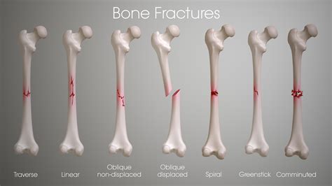 What Are The Different Types Of Bone Fractures