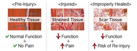 What is the Graston Technique and why do I use it? — Plus Forte ...