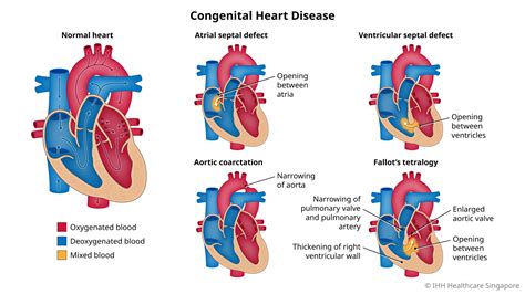 Congenital Heart Defects