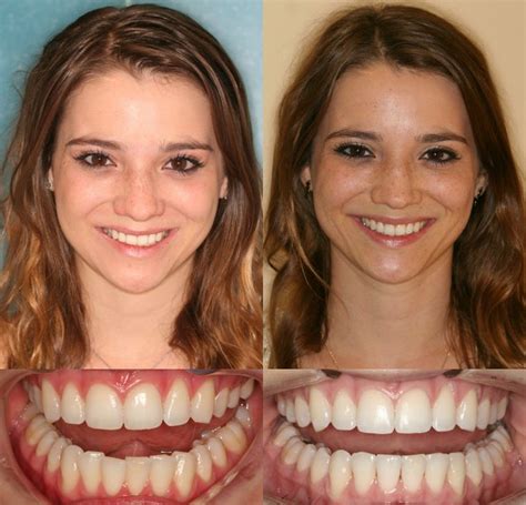 Invisalign Before and After Photos Dr. Ginger Price Elite Invisalign ...