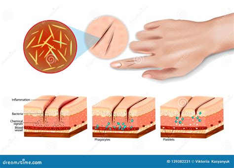 Inflammation. Immune System Vector Illustration | CartoonDealer.com ...