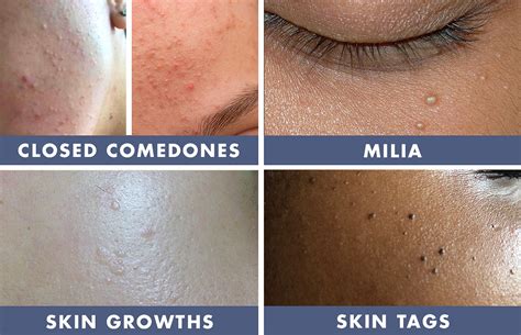 Bumps on the Skin — Age Bumps, Skin Growths and Clogged Pores