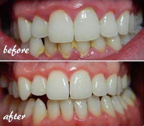 How To Remove Dental Plaque From Your Teeth Naturally