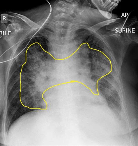 Pulmonary edema chest x ray - wikidoc