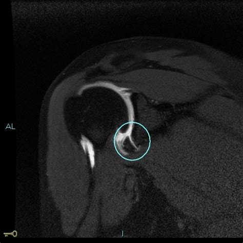 Traumatic Anterior Shoulder Instability (TUBS) - Shoulder & Elbow ...