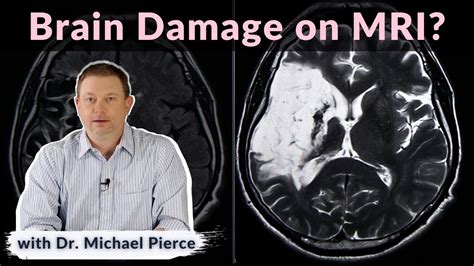 Will brain damage show on MRI? - YouTube