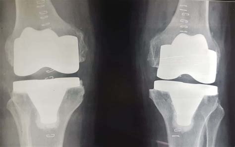 Knee Replacement Surgery Cost In Delhi - Joint Surgery In India