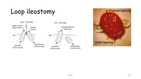 Stoma