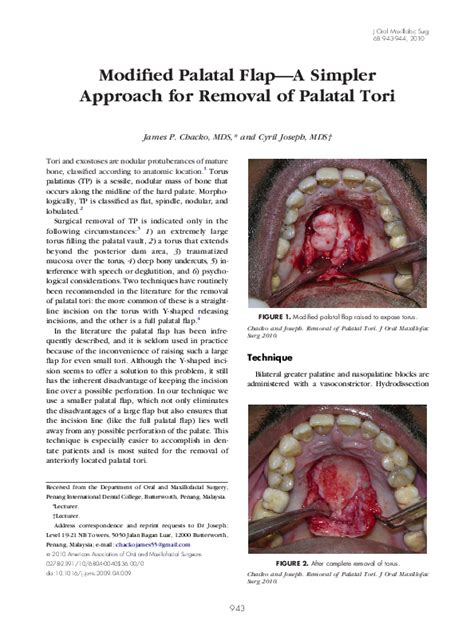 (PDF) Modified Palatal Flap—A Simpler Approach for Removal of Palatal ...