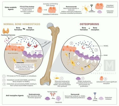 Management Of Osteoporosis - My Endo Consult