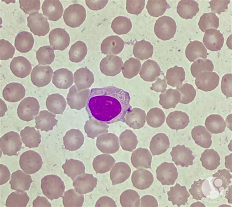 CLL with intracytoplasmic inclusions 3