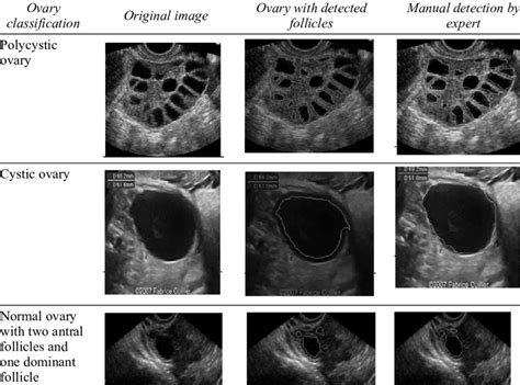 Normal Vs Polycystic Ovaries Ultrasound