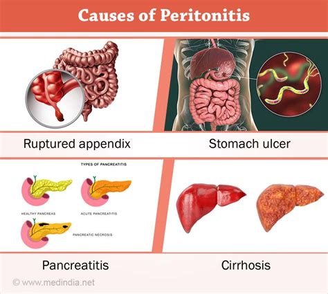 Peritonitis Causes Symptoms Diagnosis Treatment Complications | Images ...