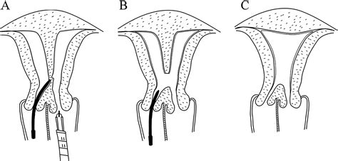 Hysteroscopic septum resection of complete septate uterus with cervical ...