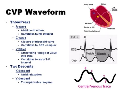 CVP and Arterial Line Waveform Interpretation Flashcards | Quizlet