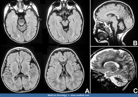 Neonate brains (basal views) | MedLink Neurology