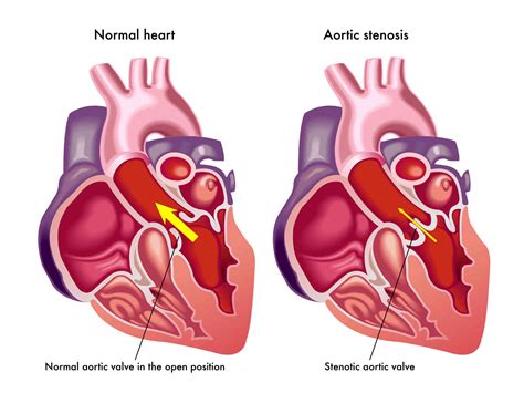 What Is A Calcified Heart Valve? - Dr. Peter Mikhail