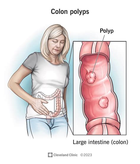 Colon Polyp Size And Type Charts, 52% OFF