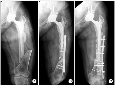 Treatment of Periprosthetic Femoral Fractures in Hip Arthroplasty