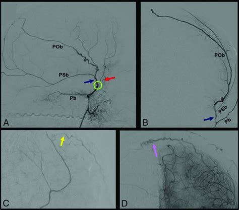 Middle Meningeal Artery: Anatomy and Variations | American Journal of ...