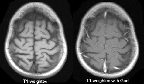 Reading an Mri Brain Scan Is Subjective - Lee Manciener