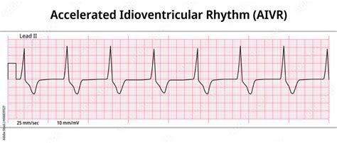 ECG Accelerated Idioventricular Rhythm - 8 Second ECG Paper ...