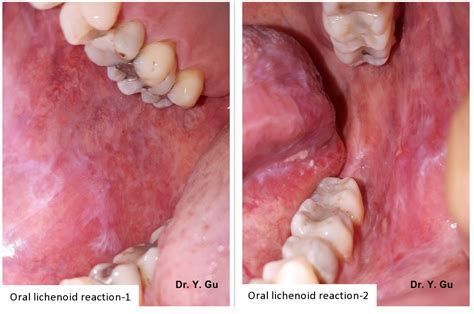 The Histopathological Difference Between Oral Lichen Planus and Oral ...