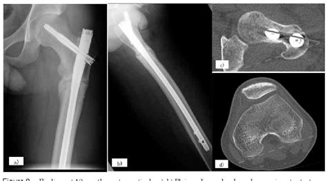 Figure 3 from Proximal Femoral Rotational Osteotomy for Symptomatic ...