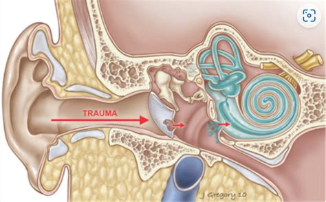 A Review on Traumatic Tympanic Membrane Perforations - Sports Medicine ...