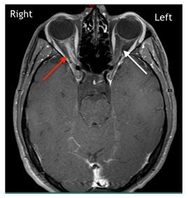 시신경염 (Optic neuritis) : 네이버 블로그