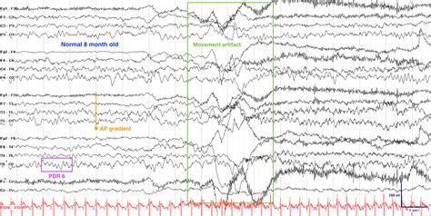 Normal Versus Abnormal Eeg