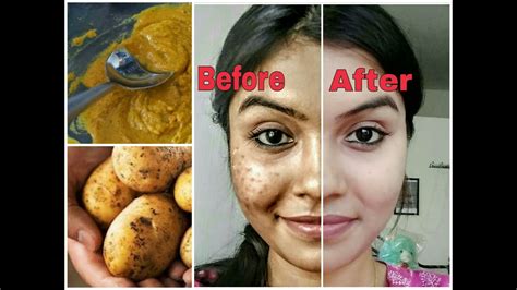 Remove dark spots in just 7 days | 100% Natural | Get rid of uneven ...