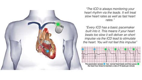 Implantable Cardioverter Defibrillator (ICD) General Information ...