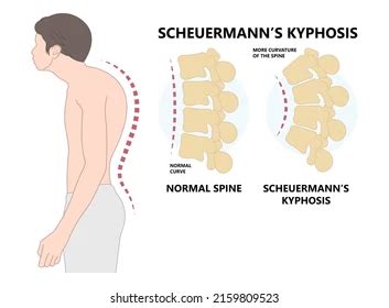 Scheuermann's Disease - Heale's Clinics