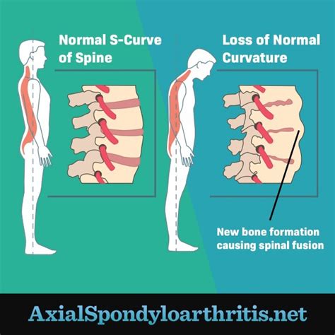 How Axial Spondyloarthritis Affects the Spine