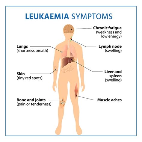 Understanding Leukemia: Causes, Symptoms, And Treatment - Ask The Nurse ...