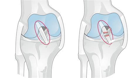 ACL Reconstruction Surgery Is a Second Hit to the Cartilage: Time to ...