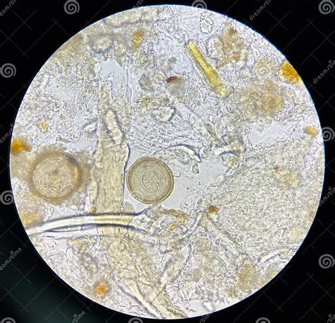 Hymenolepis Diminuta Egg Human Parasite in Stool Examination Stock ...