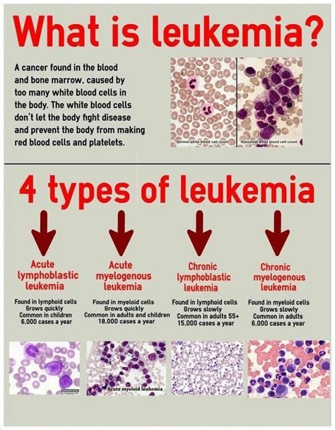 funnydoc: “4 types of leukemia!! ” | Medical laboratory science ...