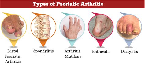 Psoriatic Arthritis - Causes, Symptoms, Diagnosis, Diet & Treatment