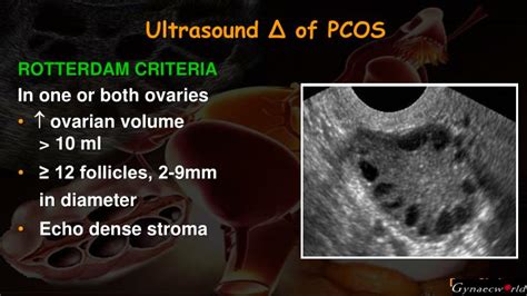 PPT - PCOS PowerPoint Presentation - ID:4052983