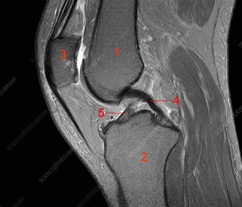 Normal knee, MRI scan - Stock Image - C026/1160 - Science Photo Library