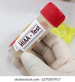 Urine Sample 5hydroxyindoleacetic Acid 5hiaa Test Stock Photo ...