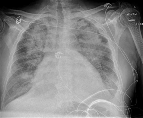 Flash Pulmonary Edema Chest X Ray